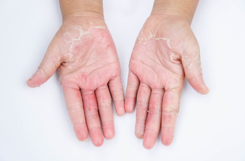 Dermatite de Contato: O que é e Como Prevenir Reações Cutâneas
