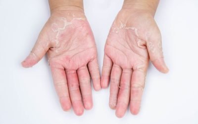 Dermatite de Contato: O que é e Como Prevenir Reações Cutâneas