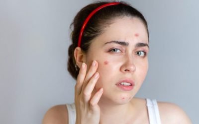 Acne: Causas, Tratamentos e Prevenção